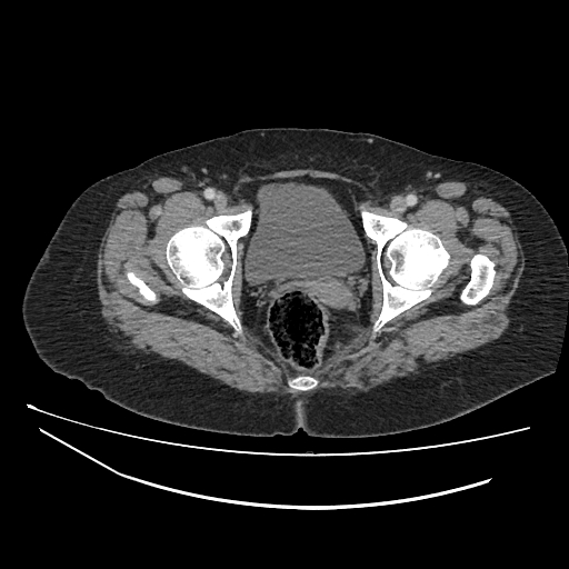 Ampullary tumor (Radiopaedia 60333-67998 A 88).jpg