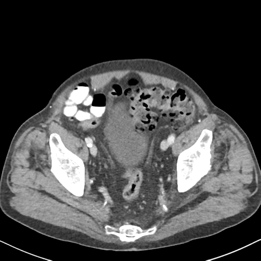File:Amyand hernia (Radiopaedia 39300-41547 A 61).png