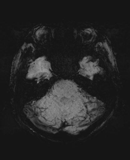 File:Amyloid angiopathy with inflammation (Radiopaedia 30360-31002 Axial SWI MIP 8).jpg
