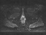 File:Anal adenocarcinoma - tumor regression grade 1 (Radiopaedia 31358-32100 Axial DWI 10).jpg