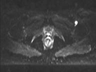 Anal adenocarcinoma - tumor regression grade 1 (Radiopaedia 31358-32100 Axial DWI 13).jpg
