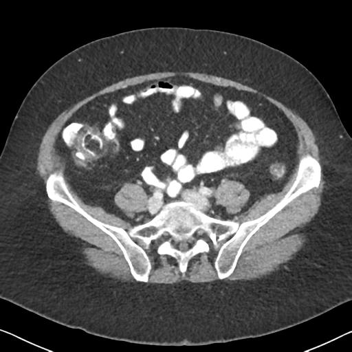 Anal adenocarcinoma - tumor regression grade 1 (Radiopaedia 31358-32103 Axial POST 51).jpg