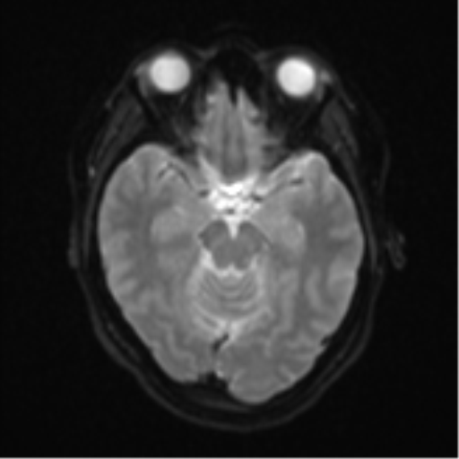 Anaplastic astroblastoma (Radiopaedia 55666-62194 Axial DWI 11).png