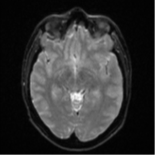 File:Anaplastic astrocytoma (Radiopaedia 57768-64731 Axial DWI 12).png