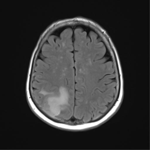 File:Anaplastic astrocytoma (Radiopaedia 86943-103160 Axial FLAIR 20).png