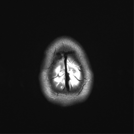 File:Anaplastic astrocytoma IDH mutant (Radiopaedia 50046-55341 Axial T2 36).png