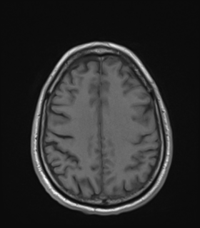 Anaplastic astrocytoma IDH wild-type (Radiopaedia 49984-55273 Axial T1 42).png