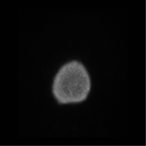 File:Anaplastic astrocytoma IDH wild-type (pseudoprogression) (Radiopaedia 42209-45276 Axial T1 C+ 152).png
