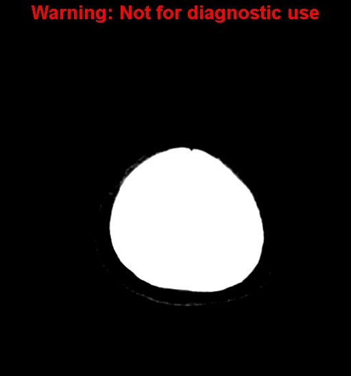 File:Anaplastic ganglioglioma (Radiopaedia 44921-48815 Axial non-contrast 28).jpg