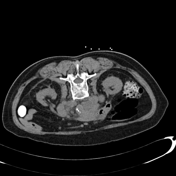 File:Anaplastic lymphoma - with CT biopsy (Radiopaedia 21643-21602 Axial non-contrast 34).jpg