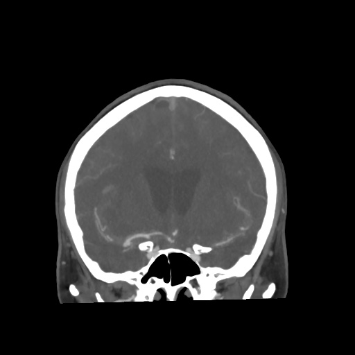 Aneursym related subarachnoid hemorrhage with hydrocephalus (Radiopaedia 45105-49084 B 31).jpg