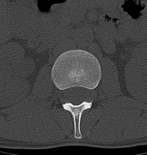 Aneurysmal bone cyst T11 (Radiopaedia 29294-29721 Axial bone window 68).jpg