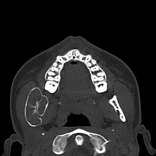 File:Aneurysmal bone cyst of the mandible (Radiopaedia 43280-46601 Axial bone window 47).jpg