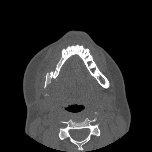 Aneurysmal bone cyst of the mandible (Radiopaedia 43280-46823 Axial bone window 42).jpg
