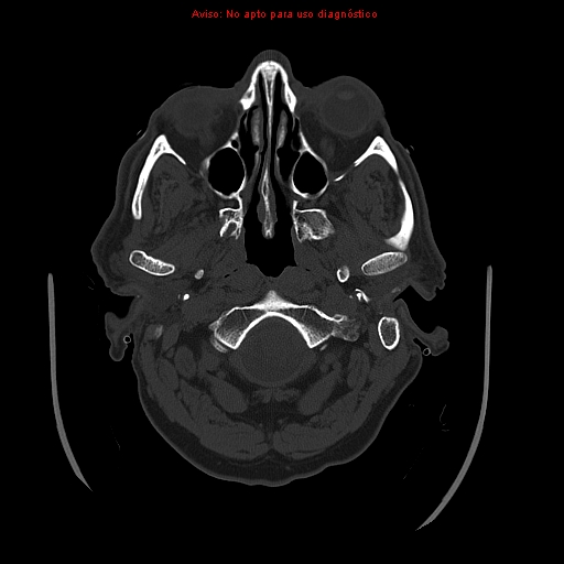 File:Aneurysmal subarachnoid hemorrhage (Radiopaedia 24740-24997 bone window 2).jpg