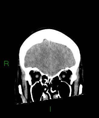 Aneurysmal subarachnoid hemorrhage with intra-axial extension (Radiopaedia 84371-99699 Coronal non-contrast 53).jpg