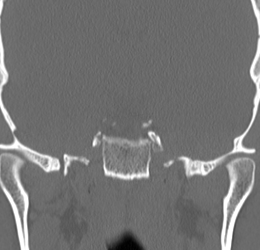 Angular epidermoid cyst (Radiopaedia 46908-51439 Coronal bone window 54).png
