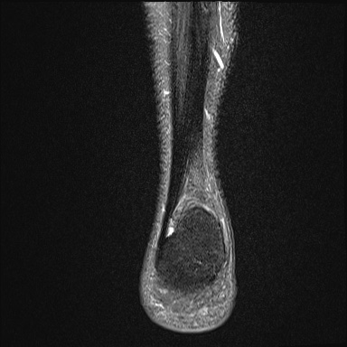 Ankle syndesmotic injury (Radiopaedia 69066-78837 Coronal PD fat sat 6).jpg