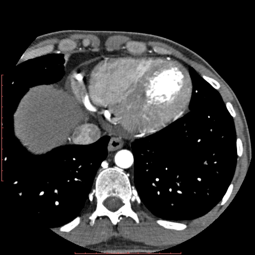 File:Anomalous left coronary artery from the pulmonary artery (ALCAPA) (Radiopaedia 70148-80181 A 319).jpg