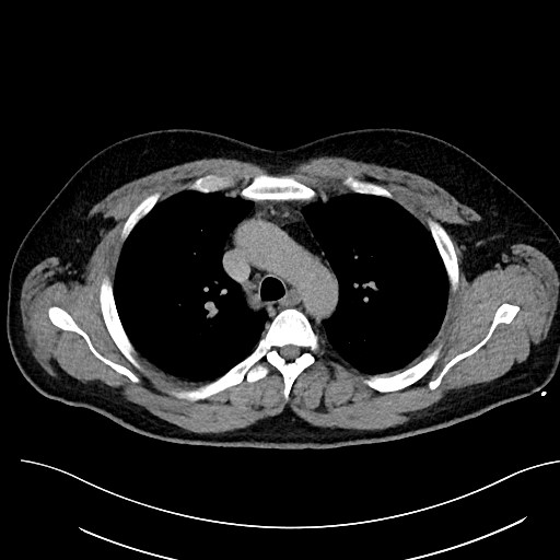 File:Anomalous origin of the left coronary artery with malignant course (Radiopaedia 77842-90126 Axial non-contrast 12).jpeg