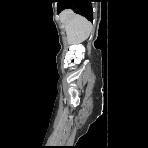 Anorectal carcinoma (Radiopaedia 44413-48064 C 8).jpg