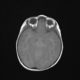 File:Anoxic brain injury (Radiopaedia 79165-92139 Axial T1 11).jpg