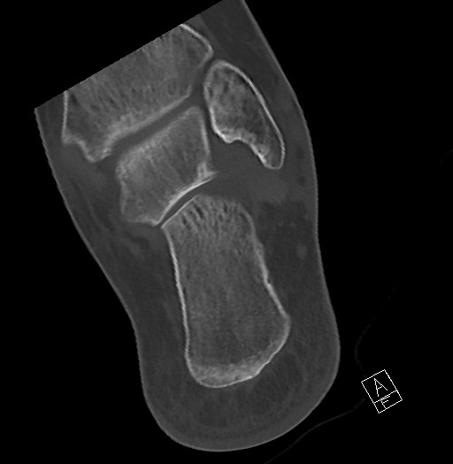 Anterior calcaneal process fracture (Radiopaedia 63353-71943 Axial bone window 111).jpg