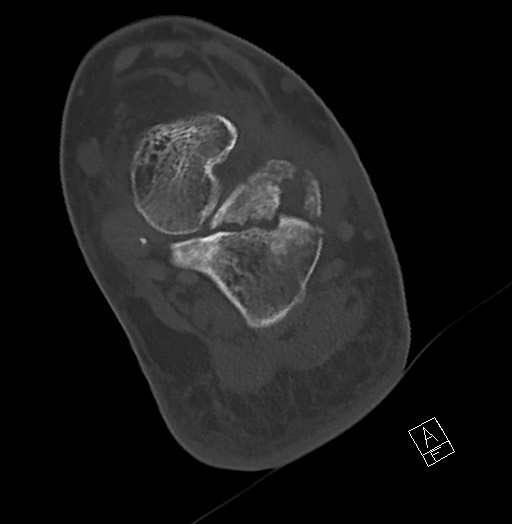File:Anterior calcaneal process fracture (Radiopaedia 63353-71943 Axial bone window 95).jpg