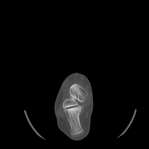 Anterior calcaneal process fracture (Radiopaedia 82590-96762 Axial bone window 18).jpg