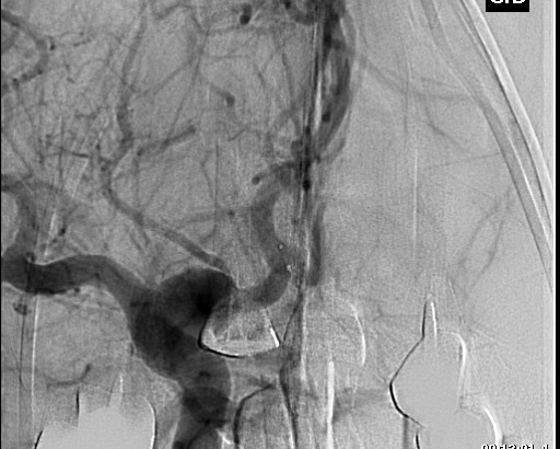 File:Anterior cerebral artery aneurysm (Radiopaedia 80683-94130 A 6).jpg