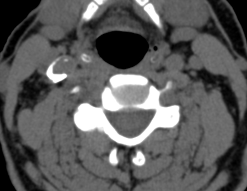 Anterior cervical postdiscectomy arthrodesis (Radiopaedia 32678-33646 Axial non-contrast 40).jpg