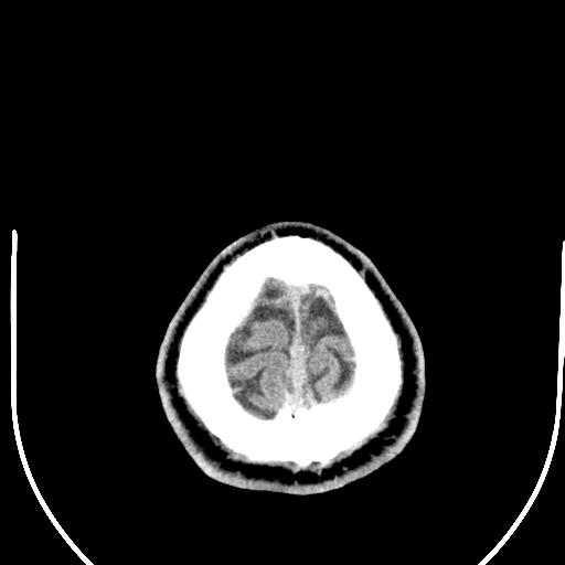 Anterior choroidal artery infarct (Radiopaedia 55106-61480 Axial non-contrast 62).jpg