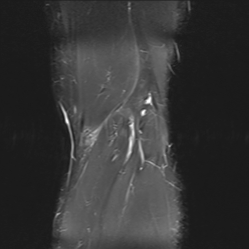 File:Anterior cruciate ligament full thickness tear (Radiopaedia 66268-75467 Coronal STIR 21).jpg