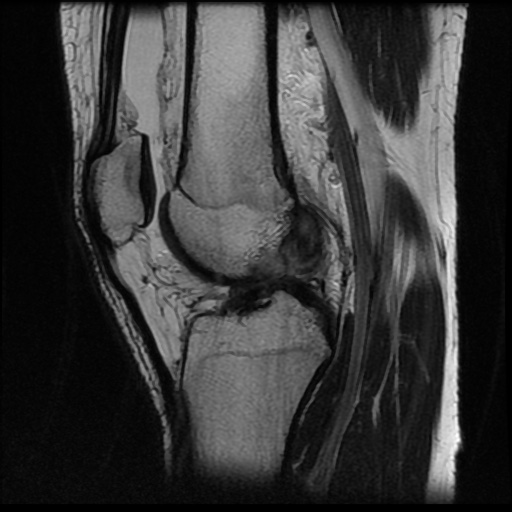 File:Anterior cruciate ligament tear (Radiopaedia 61500-69462 Sagittal T2 11).jpg