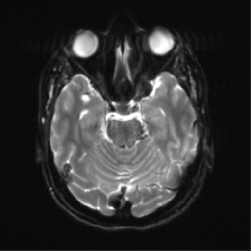 Anterior temporal lobe perivascular space (Radiopaedia 40946-43650 Axial DWI 9).png