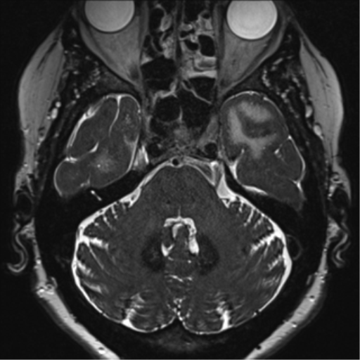 Anterior temporal pole cysts (Radiopaedia 46629-51102 Axial 14).png