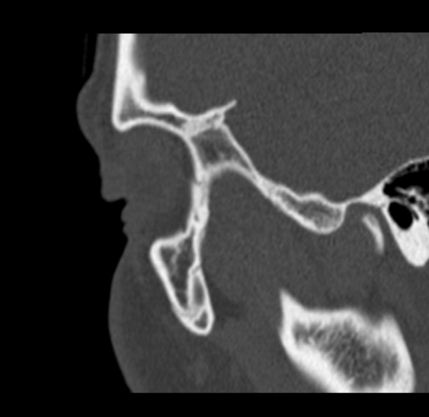 Antrochoanal polyp (Radiopaedia 33984-35202 Sagittal bone window 2).jpg