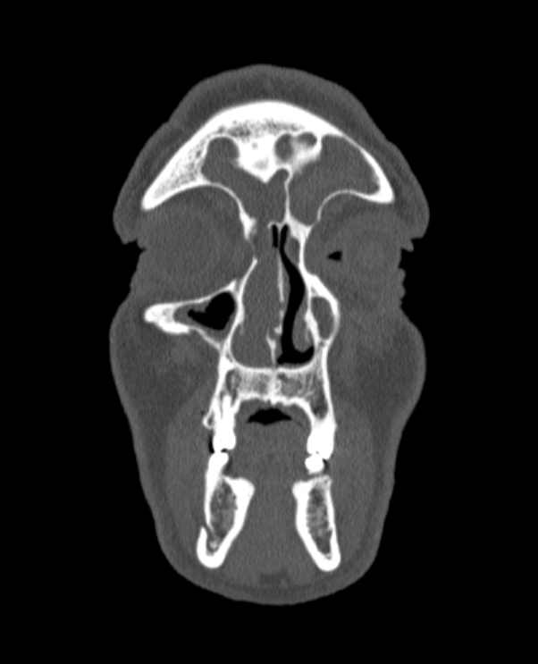 Antrochoanal polyp (Radiopaedia 79011-92169 Coronal bone window 72).jpg