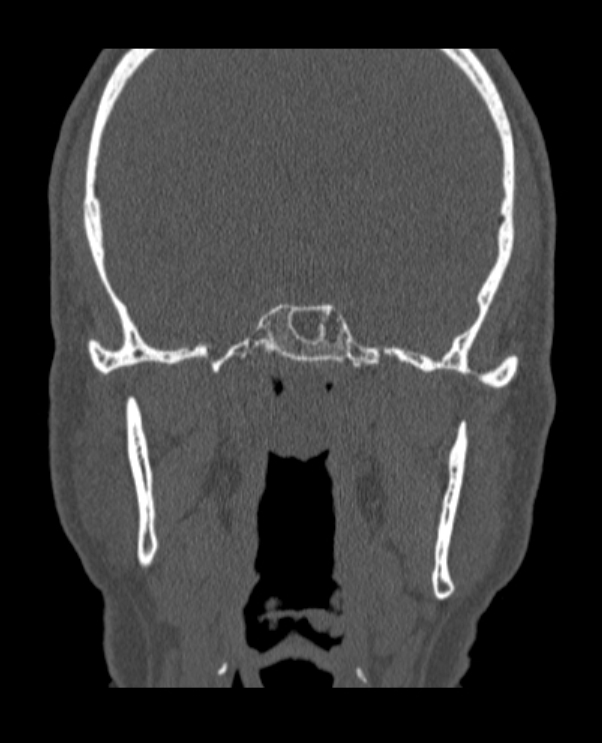 Antrochoanal polyp (Radiopaedia 79011-92169 Coronal bone window 9).jpg