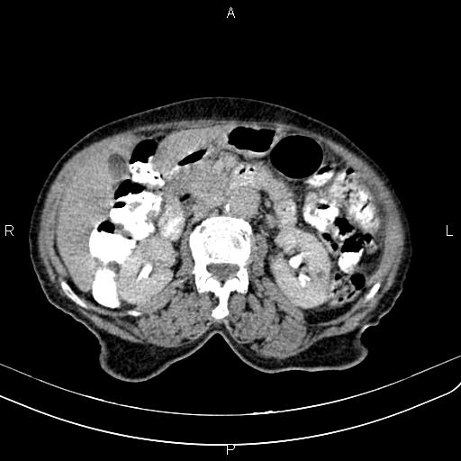 Aortic aneurysm and Lemmel syndrome (Radiopaedia 86499-102554 Axial C+ delayed 33).jpg