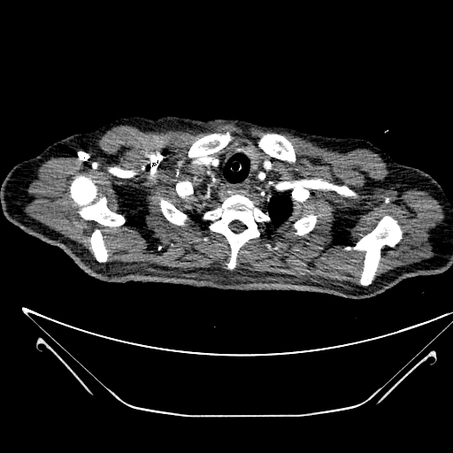 Aortic arch aneurysm (Radiopaedia 84109-99365 B 67).jpg