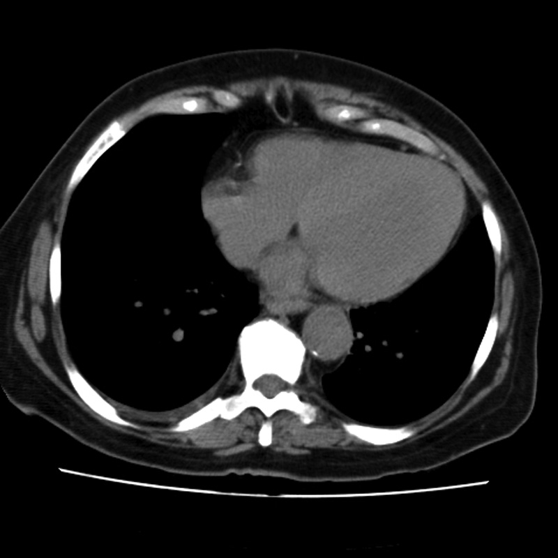 Aortic arch pseudoaneurysm (Radiopaedia 8534-9368 Axial non-contrast 51).jpg
