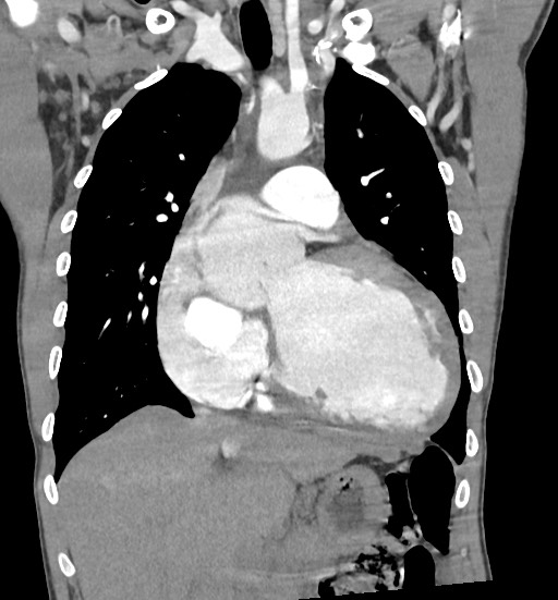 Aortic coarctation with aneurysm (Radiopaedia 74818-85828 C 48).jpg