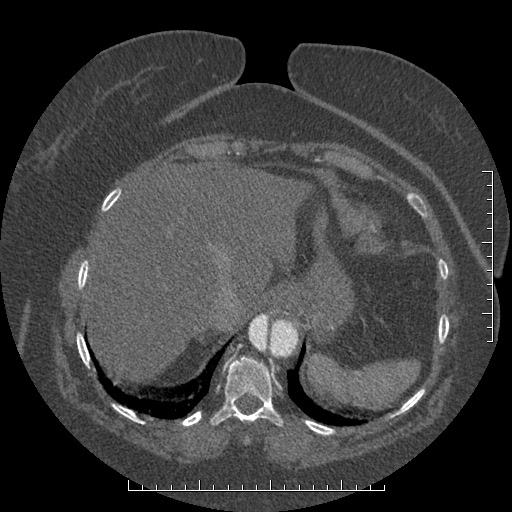 File:Aortic dissection- Stanford A (Radiopaedia 35729-37268 B 21).jpg
