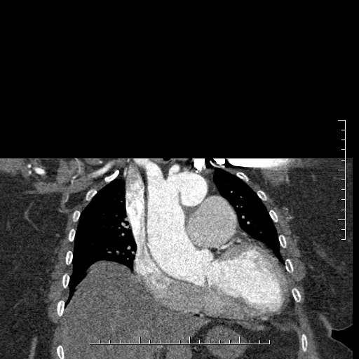 Aortic dissection- Stanford A (Radiopaedia 35729-37268 E 43).jpg