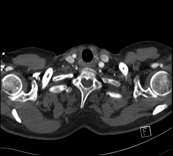 File:Aortic dissection (CTPA) (Radiopaedia 75506-86750 A 2).jpg