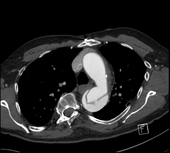 File:Aortic dissection (CTPA) (Radiopaedia 75506-86750 A 31).jpg