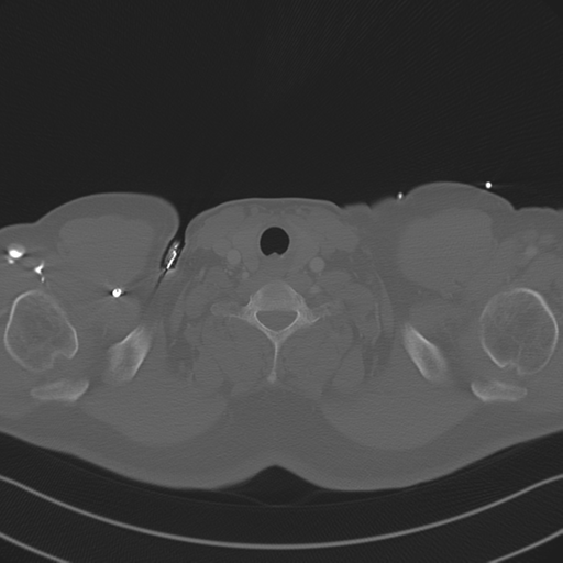 File:Aortic dissection (Radiopaedia 50763-56234 Axial bone window 5).png