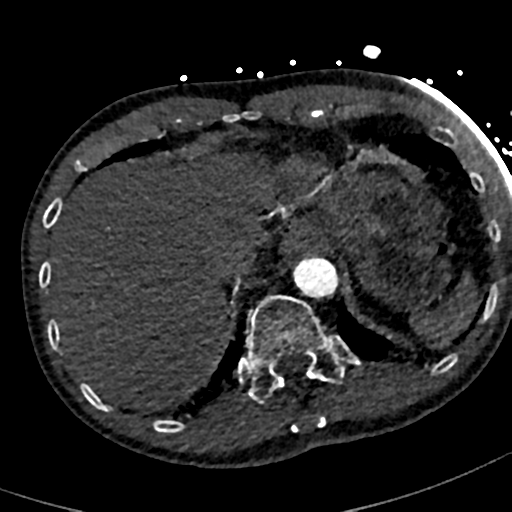 File:Aortic dissection - DeBakey type II (Radiopaedia 64302-73082 A 81).png