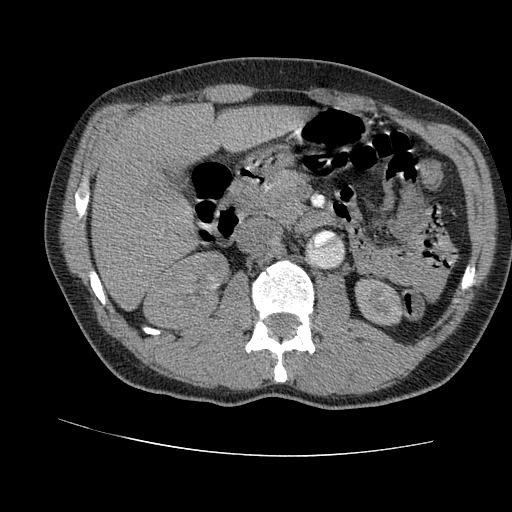 File:Aortic dissection - Stanford A -DeBakey I (Radiopaedia 28339-28587 B 127).jpg